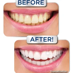 Miracle Smile® Teeth Whitening Gel - 2 Shades Whiter in 2 Minutes
